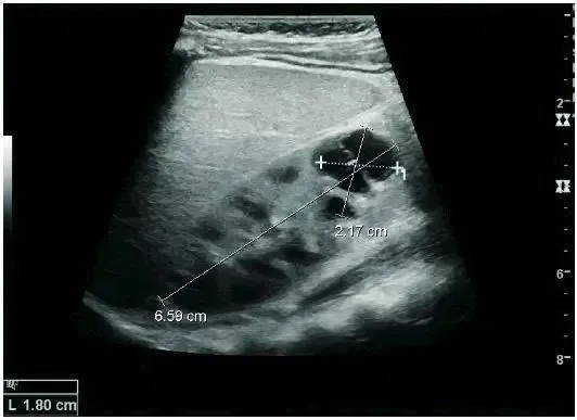 Kidney Ultrasound Images (POCUS): 4 Common Conditions and Scan